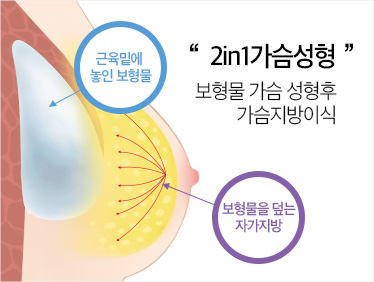 자주묻는질문 1 페이지 | 미다스성형외과 줄기세포가슴성형