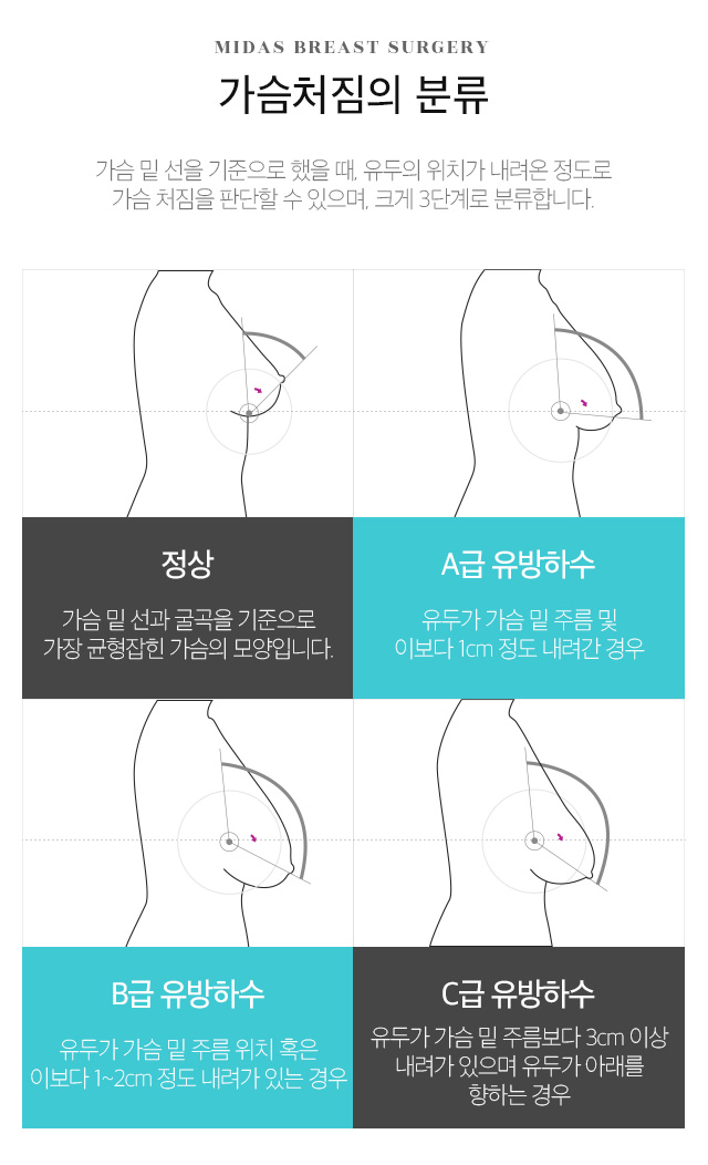 유방하수 | 미다스성형외과 줄기세포가슴성형